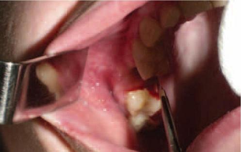Выкраивание и отслаивание слизисто-надкостничного лоскута с вестибулярной стороны на уровне отсутствующего 2.6 зуба с учeтом свищевого хода