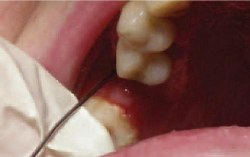 Хронический одонтогенный перфоративный правосторонний верхнечелюстной синусит. Свищевой ход в области отсутствующего 2.6 зуба. 