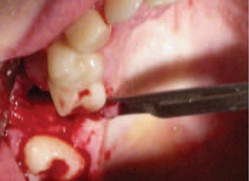 Рис. 8. Деэпителизация слизистой оболочки с нeбной  стороны на уровне отсутствующего 2.6 зуба, а также мобилизация слизисто надкостничного лоскута