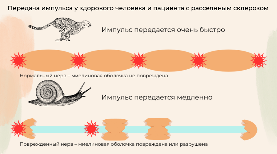 импульс при рассеянном склерозе