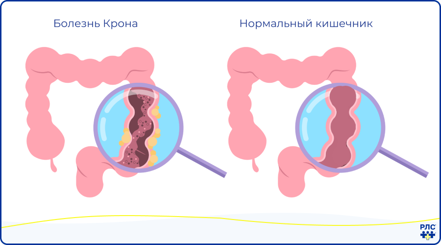 Болезнь Крона