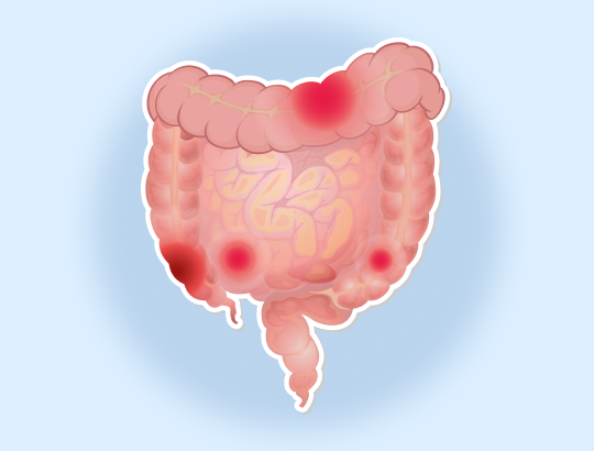 Фекальный кальпротектин: может ли анализ кала заменить колоноскопию?