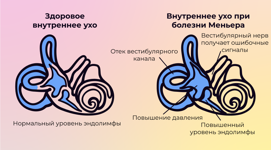 болезнь Меньера