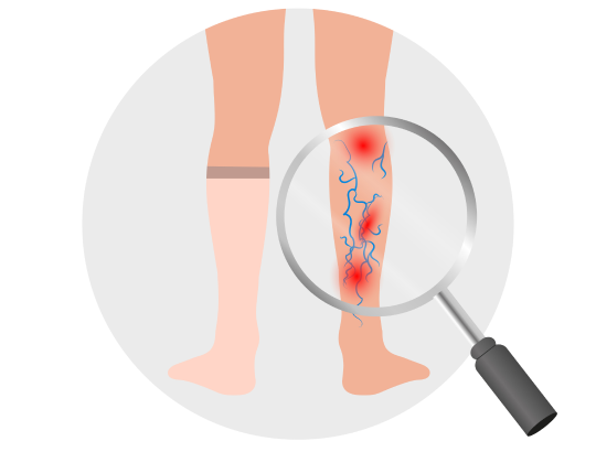 Шкала Уэллса для диагностики тромбоза глубоких вен