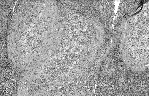 Лимфома Ходжкина. Вариант: нодулярный склероз