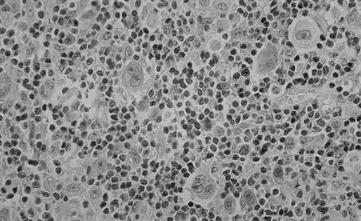 Лимфома Ходжкина. Вариант: смешанно-клеточный