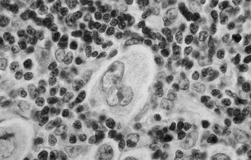 Лимфома Ходжкина. Биопсия увеличенного лимфатического узла