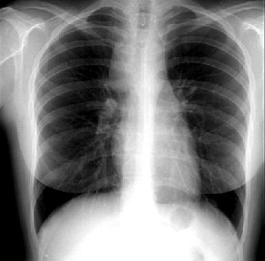Лимфома Ходжкина. Рентгенограмма грудной клетки в прямой проекции