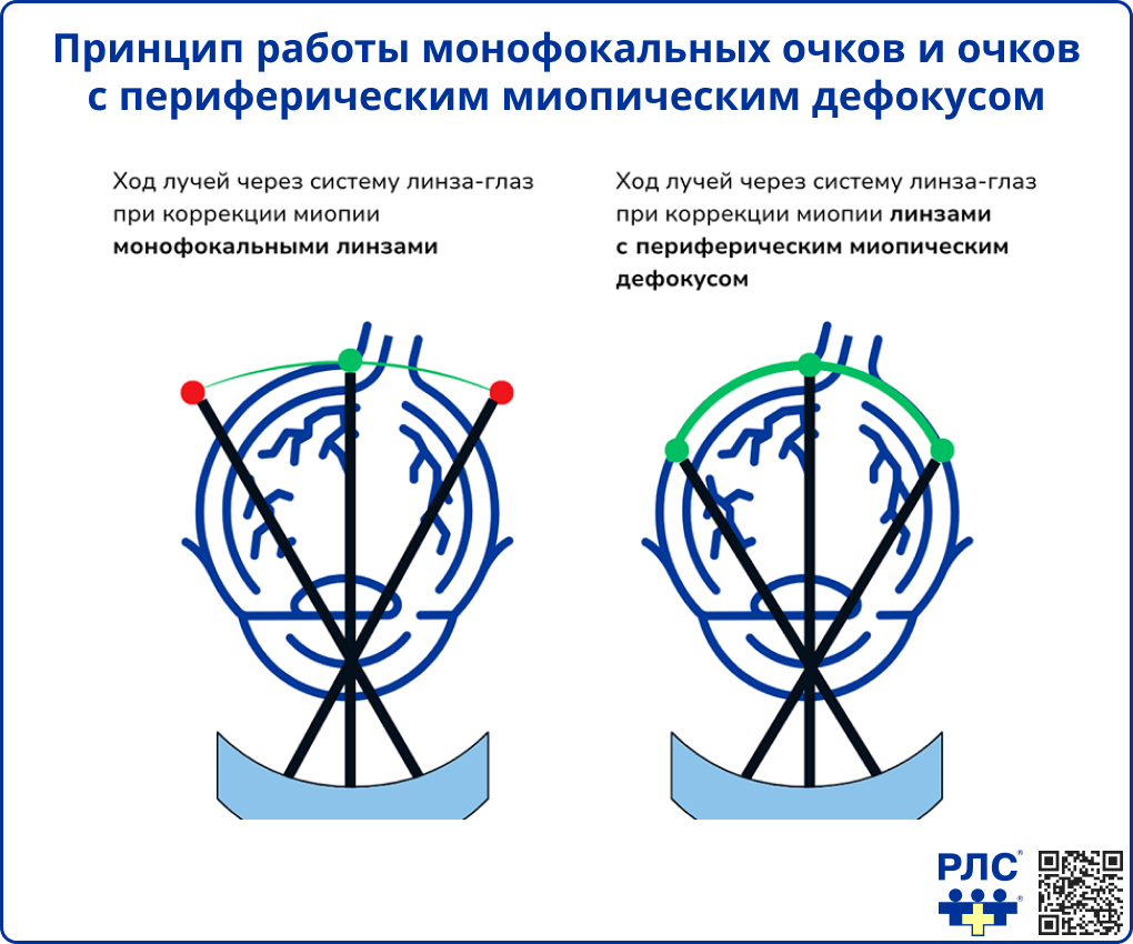 Принцип работы монофокальных очков и очков с периферическим миопическим дефокусом