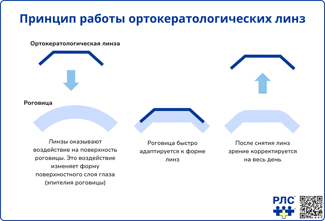 Принцип работы ортокератологических линз
