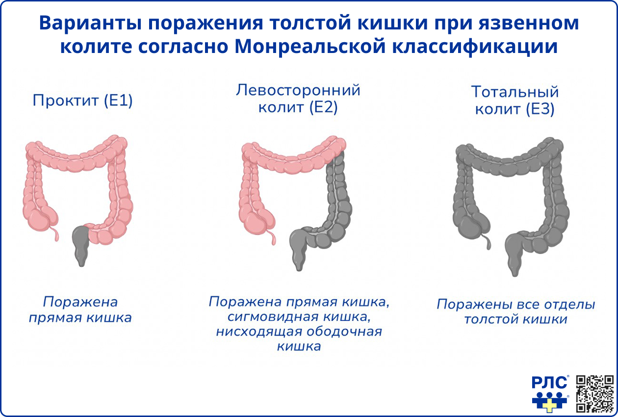Варианты поражения толстой кишки согласно Монреальской классификации