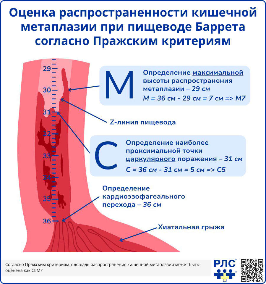 Оценка распространенности кишечной метаплазии при пищеводе Баррета согласно Пражским критериям