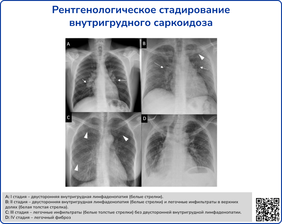 Рентгенологическое стадирование внутригрудного саркоидоза