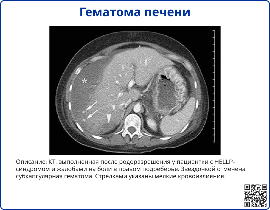 Гематома печени