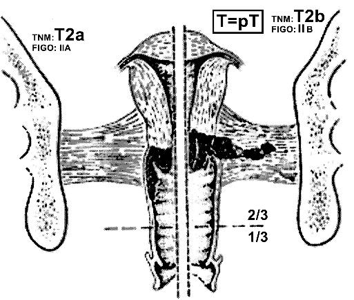 Рак шейки матки IIA и IIB стадий