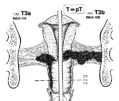 Рак шейки матки IIIA и IIIB стадий