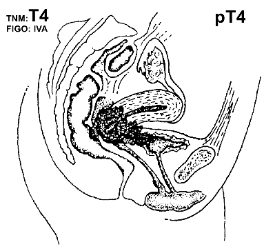 Рак шейки матки VIA стадии