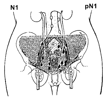 Рак шейки матки IIIB стадии