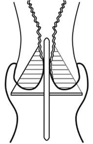 Электроконизация шейки матки