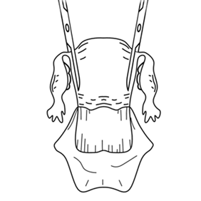 Отсепаровка брюшины мочевого пузыря