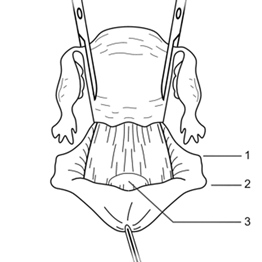 Отсепаровка брюшины прямой кишки