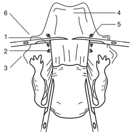 Завершение мобилизации матки с придатками и верхней третью влагалища