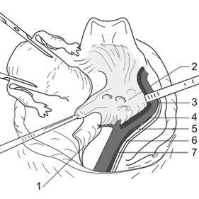 Одноблочное удаление жировой клетчатки с регионарными лимфатическими узлами
