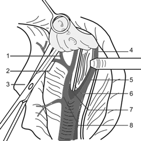 Удаление подвздошных и обтураторных лимфатических узлов