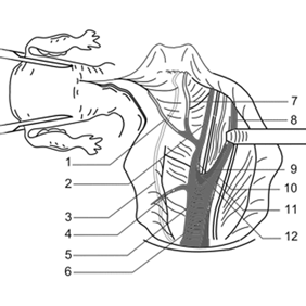 Вид операционного поля после регионарной лимфаденэктомии