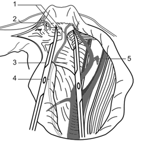 Пересечение пузырно-маточной связки