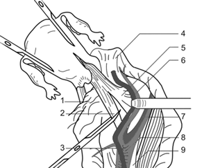 Клеммирование крестцово-маточной связки