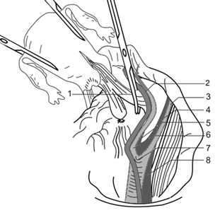 Клеммирование кардинальной связки