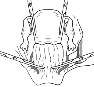 Наложение зажимов на границе верхней и средней трети влагалища