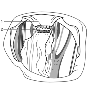 Ушивание культи влагалища