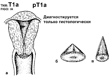 Рак шейки матки IA стадии