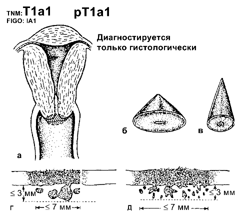 Рак шейки матки IA1 стадии