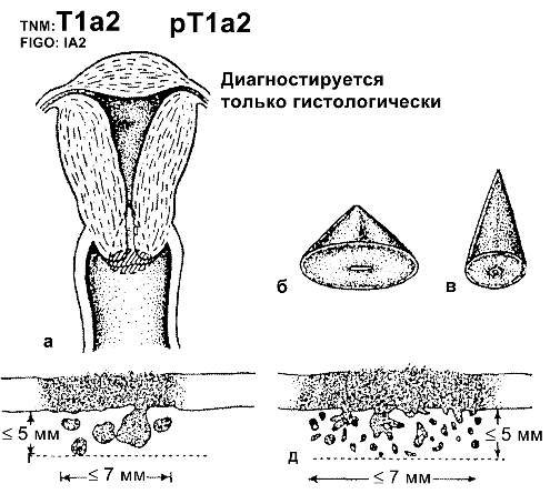 Рак шейки матки IA2 стадии