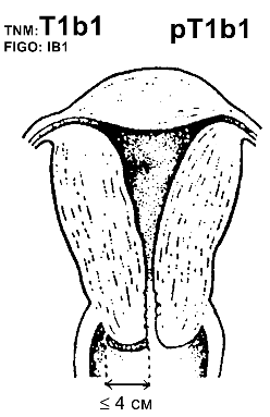 Рак шейки матки IB1 стадии