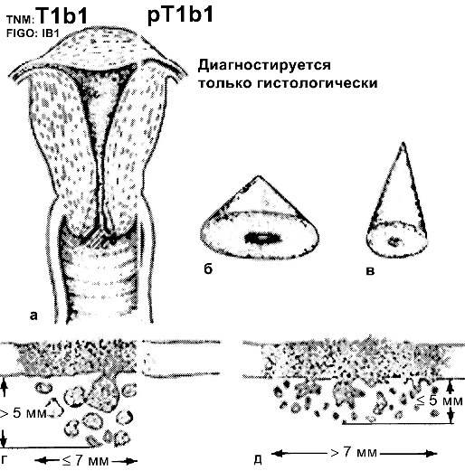 Рак шейки матки IB1 стадии
