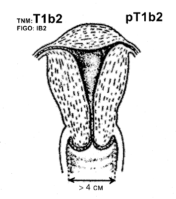 Рак шейки матки IB2 стадии