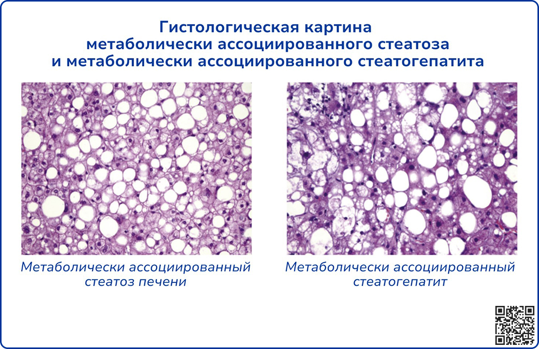 Гистологическая картина метаболически ассоциированного стеатоза и метаболически ассоциированного стеатогепатита