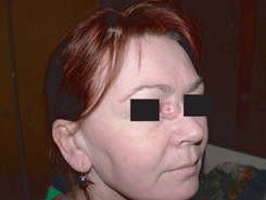 Базально-клеточный рак кожи внутреннего угла правого глаза