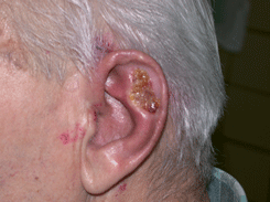 Плоскоклеточный рак кожи левой ушной раковины