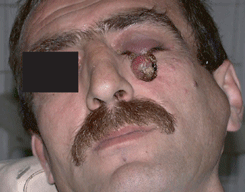 Рак из придатков кожи верхнего века левого глаза с метастазами в околоушные лимфатические узлы