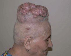 Цилиндрома кожи волосистой части головы