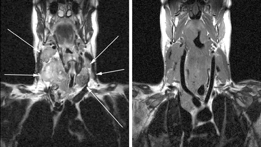 МРТ: опухолевое поражение обеих долей щитовидной железы, метастазы в лимфатические узлы шеи с обеих сторон и средостение