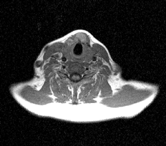 МРТ: опухолевое поражение перешейка щитовидной железы