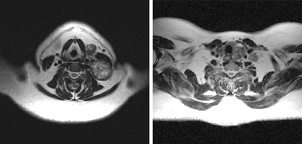 МРТ: опухолевое поражение нижнего полюса левой доли щитовидной железы