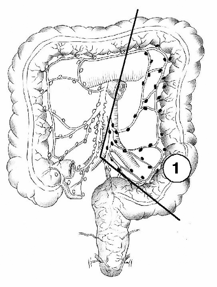 C18 Злокачественное новообразование ободочной кишки: описание болезни в ...
