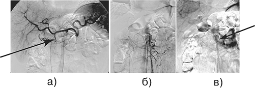 Больной М., 72 года. Диагноз: рак головки поджелудочной железы с инвазией верхней брыжеечной вены